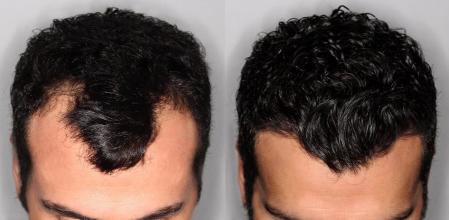 Recupera tu cabello con un implante capilar