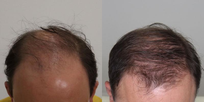 Recupera tu cabello con un implante capilar