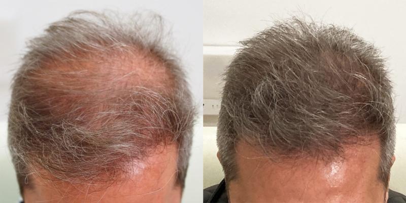 Recupera tu cabello con un implante capilar